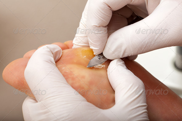 Remove skin on a wart with the scalpel
